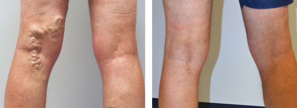 Grianghraf roimh agus tar éis Veniselle a úsáid, an taithí ar uachtar a úsáid