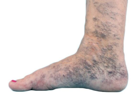 Veins Varicose ar na cosa