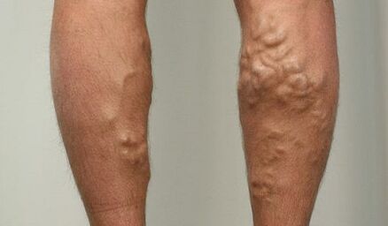 Comharthaí féitheacha varicose
