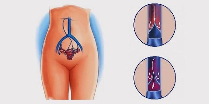 Veins varicose an pelvis