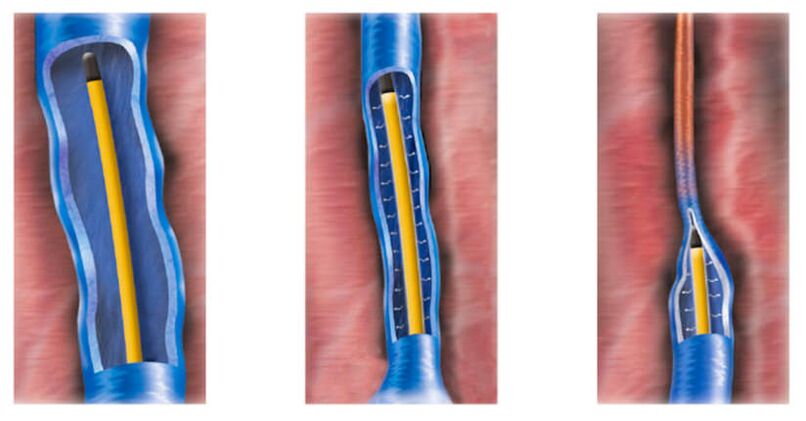 ablation radaimhinicíochta mar mhodh chun veins varicose a chóireáil