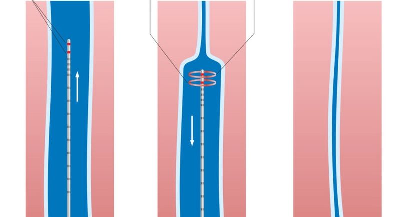 cóireáil léasair do veins varicose ar na cosa