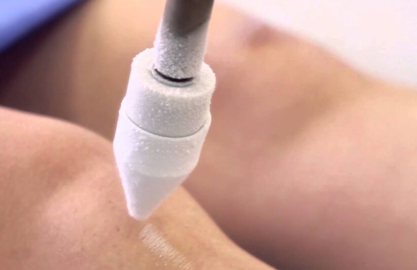 cóireáil veins varicose ar na cosa le cryotherapy