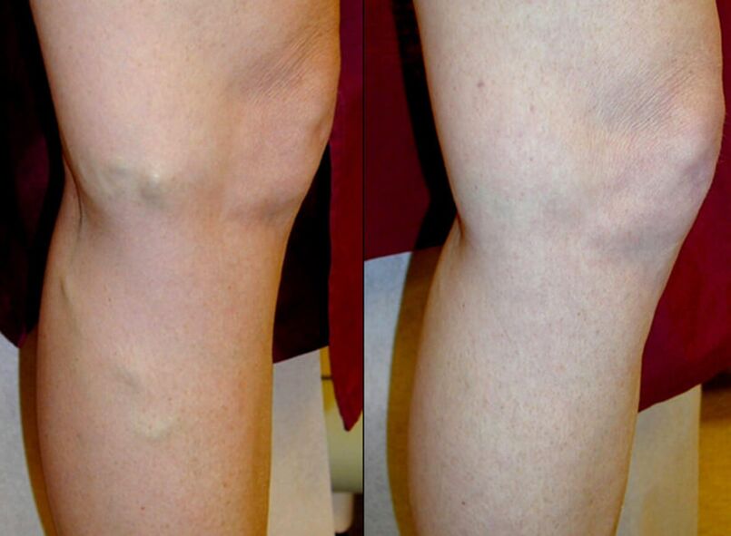 modhanna cóireála veins varicose ar na cosa